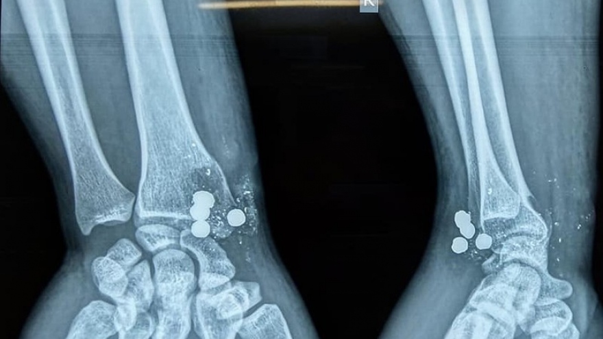 	Súng kíp phát nổ bắn 5 viên đạn vào cổ tay người đàn ông