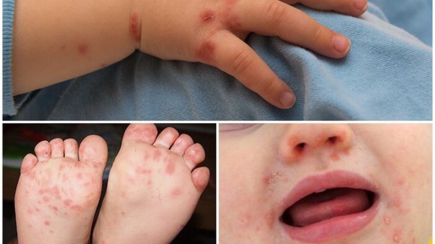 Số ca mắc tay chân miệng ở trẻ tăng tại Quảng Ninh tăng đột biến