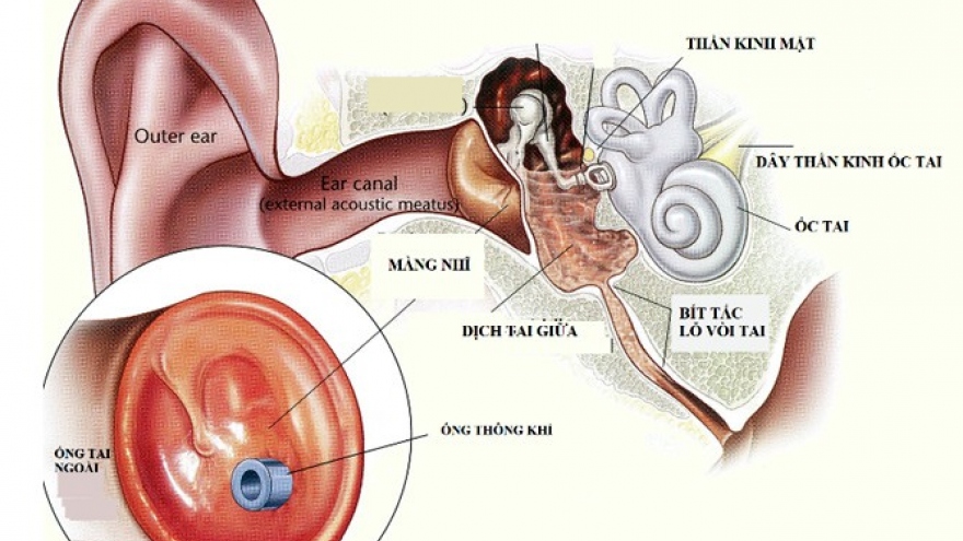 Đặt ống thông khí để điều trị viêm tai giữa