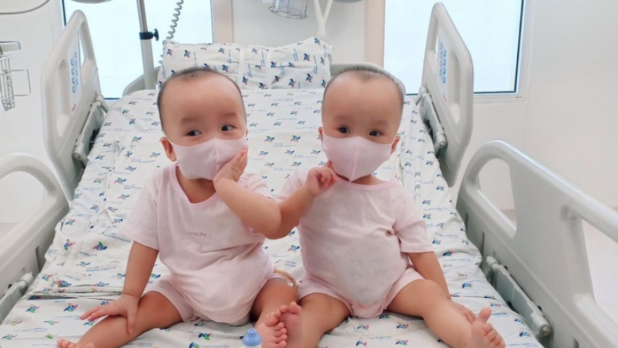 Loving photos show conjoined twins after removal of leg cast 
