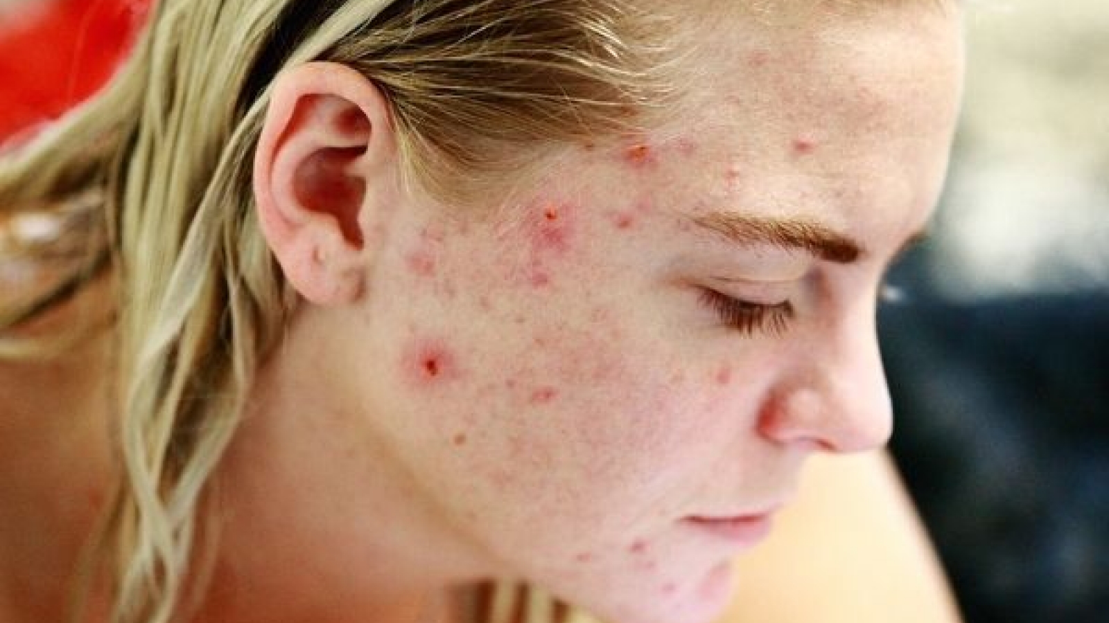 Cách đối phó với tình trạng da kích ứng, nổi mụn