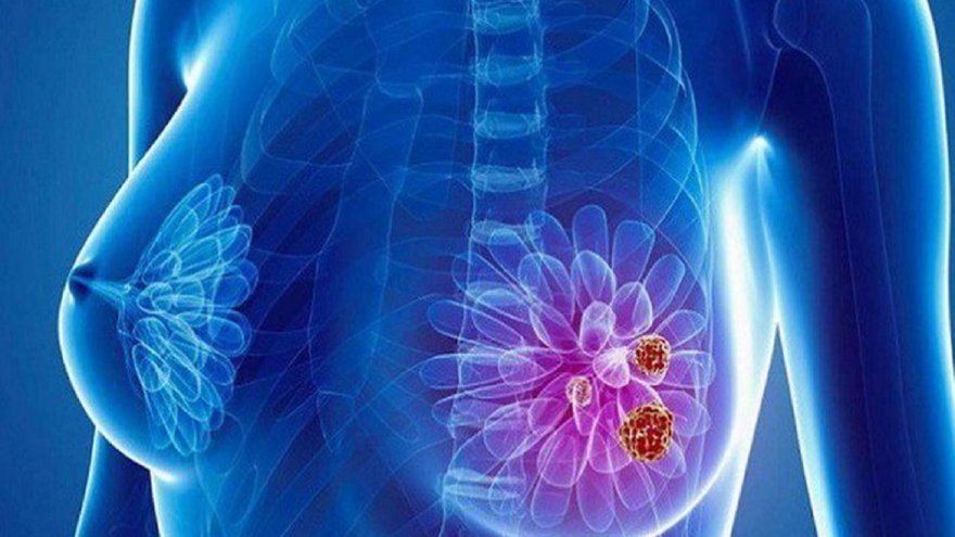 Kỹ thuật mới phát hiện sớm ung thư vú