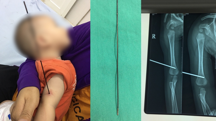 Chơi đùa cùng anh, bé trai 6 tháng tuổi bị nan ô đâm xuyên cánh tay