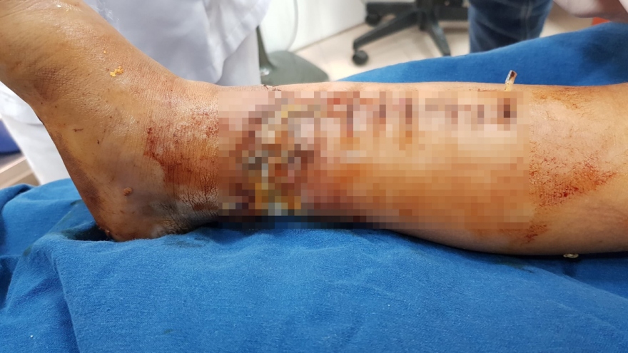 Bé trai 7 tuổi bị dập nát cẳng chân do máy xúc múc nhầm