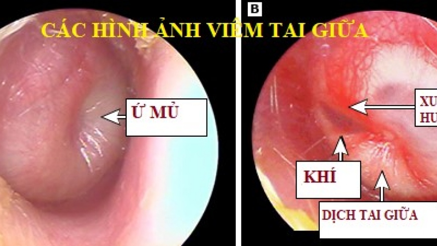 Trẻ bị viêm tai giữa- chăm sóc như thế nào?