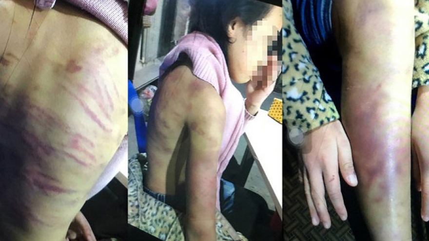 Bé gái 12 tuổi nghi bị bạo hành, xâm hại tình dục: Hà Nội chỉ đạo khẩn