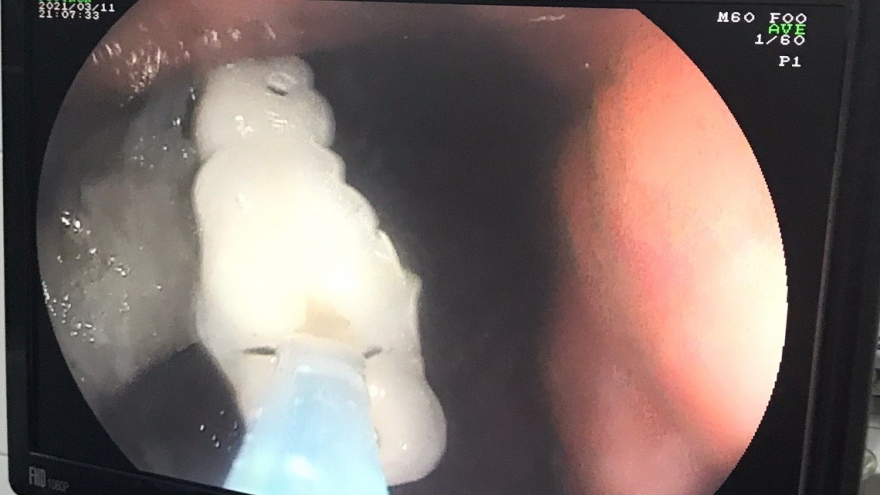 Can thiệp lấy 4 răng giả "lạc" trong dạ dày của bệnh nhân 61 tuổi