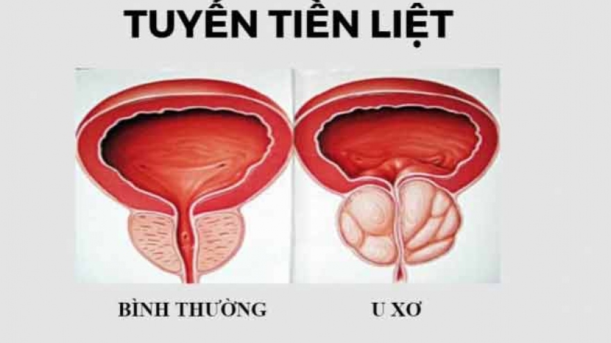 Phì đại tuyến tiền liệt - nỗi ám ảnh của các quý ông