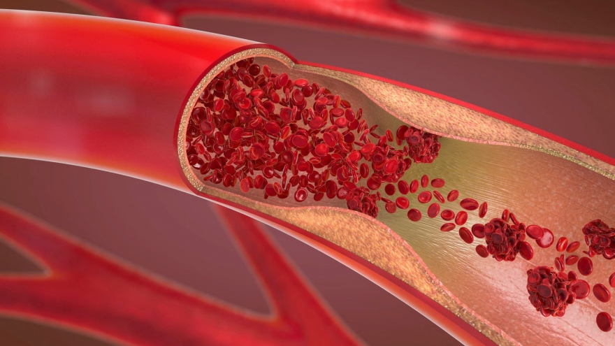 7 dấu hiệu cảnh báo có cục máu đông trong cơ thể bạn