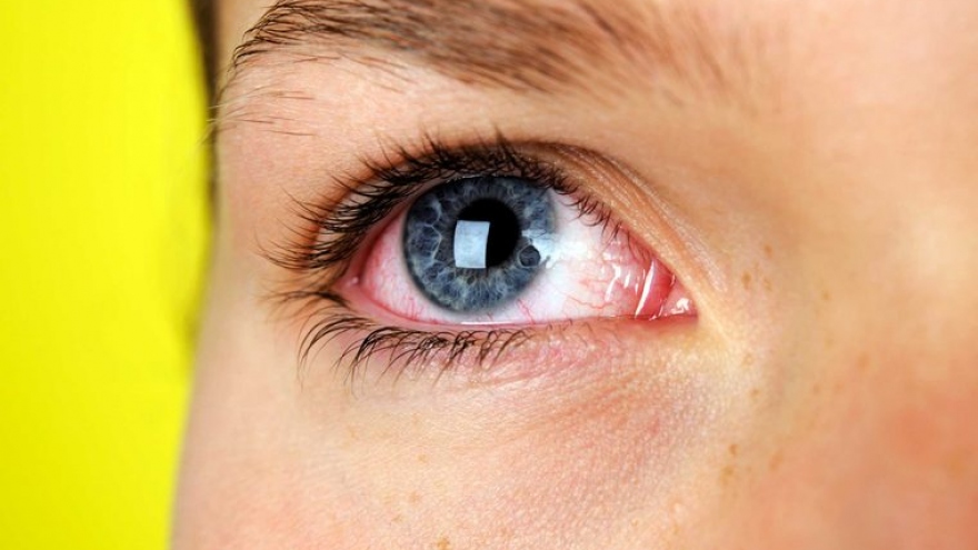 Những dấu hiệu cho thấy bạn mắc hội chứng khô mắt