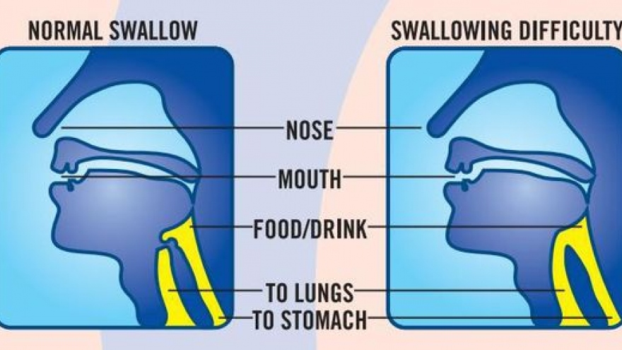 Có thể bạn đã bị rối loạn chức năng nuốt mà không biết!
