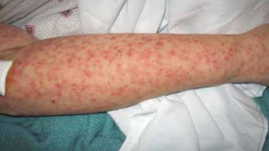 Dịch sốt virus Chikungunya bùng phát tại 13 tỉnh ở Campuchia