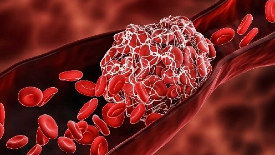 Xác định nguyên nhân COVID-19 gây các cục máu đông đe dọa tính mạng