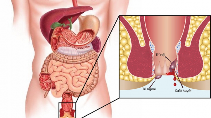 Các biện pháp khắc phục bệnh trĩ tại nhà