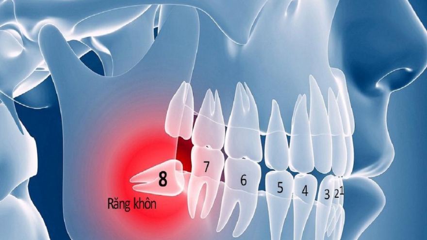 Nhổ răng khôn có thể cải thiện vị giác của bạn?