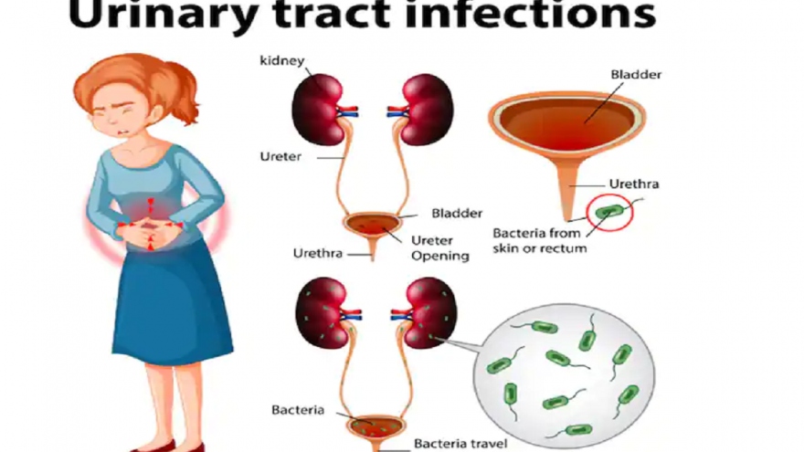 Các biện pháp giúp giảm các triệu chứng của nhiễm trùng đường tiết niệu