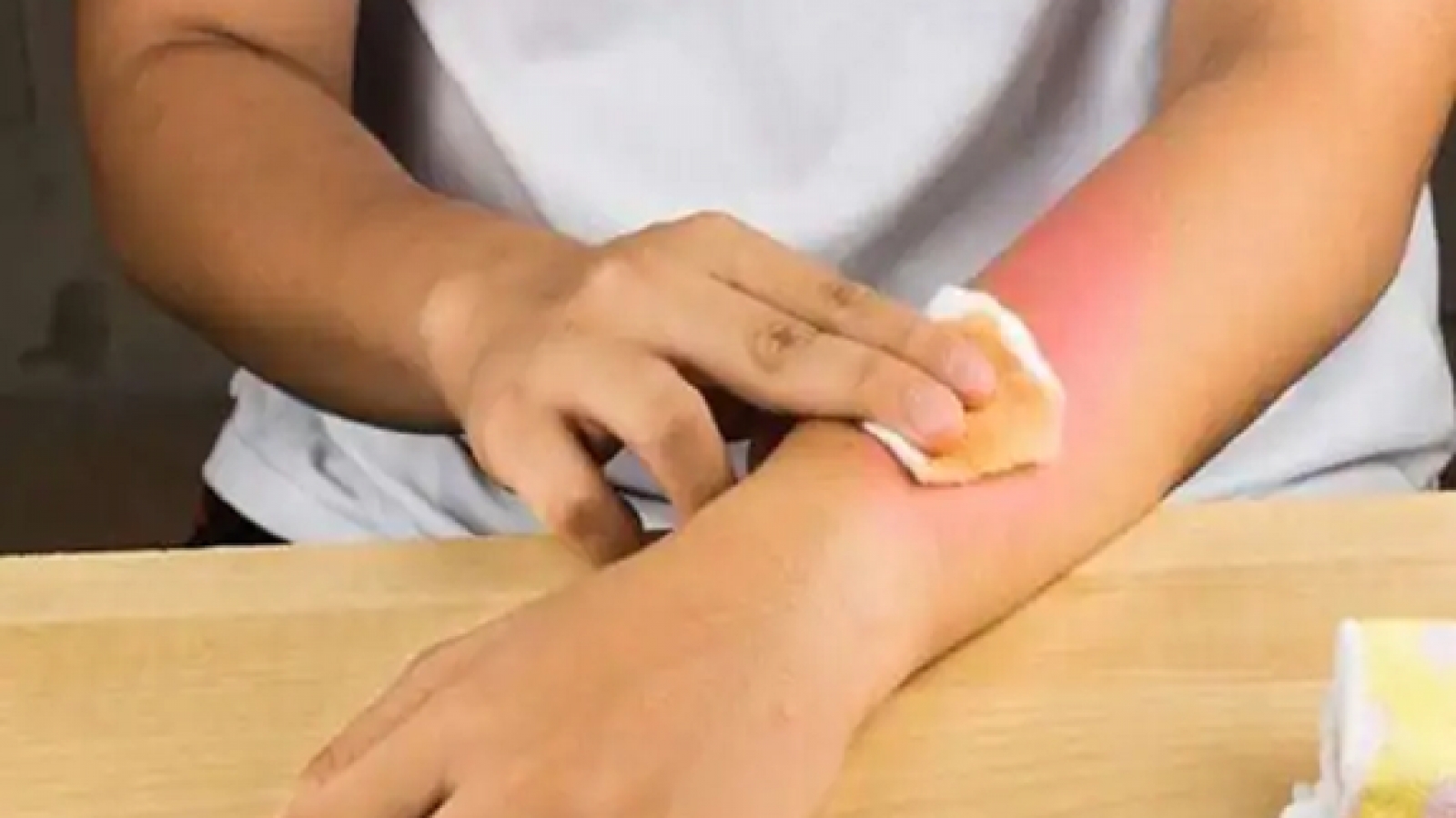 5 biện pháp làm dịu vết bỏng tại nhà