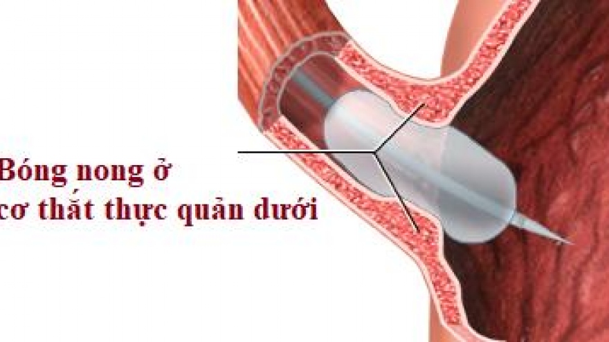 Không nuốt được vì chứng co thắt thực quản