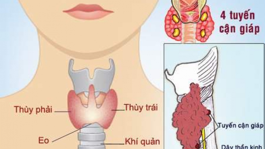 Bị thay đổi giọng, mất giọng sau phẫu thuật tuyến giáp!