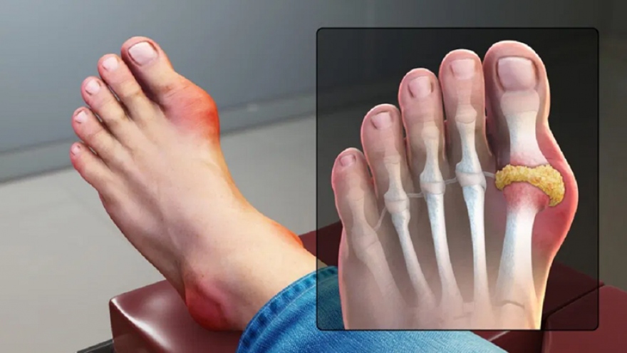 Phân biệt bệnh Gout và bệnh viêm khớp dạng thấp