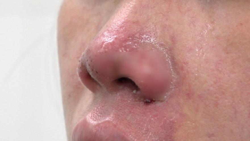 Mũi của một phụ nữ ở TP.HCM bị biến chứng hoại tử vì tiêm filler