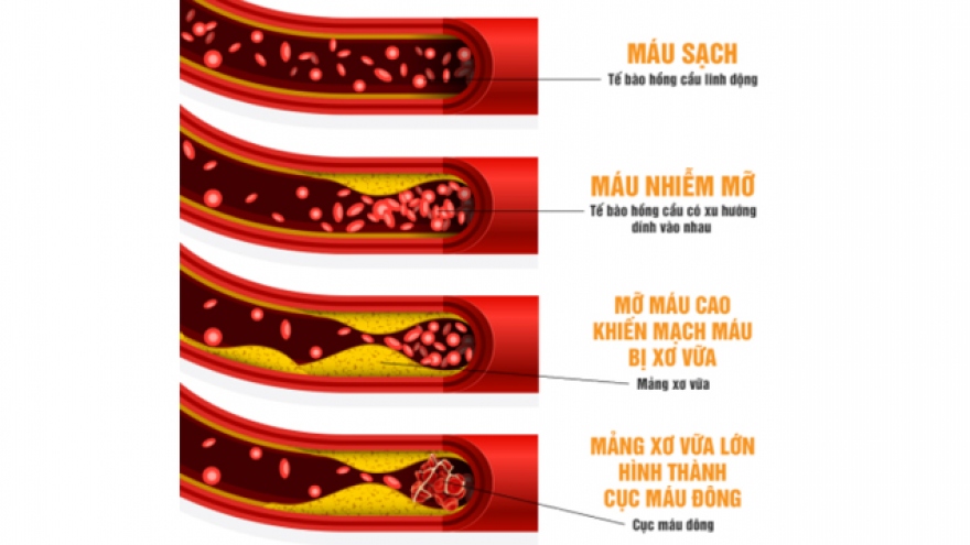 Bí quyết hạ mỡ máu cao cực hiệu quả từ Nhật Bản