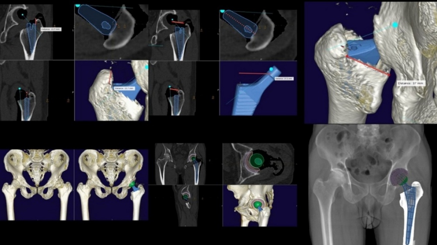 Vinmec ứng dụng thành công kỹ thuật “cá thể hóa” thay khớp háng “4 không”