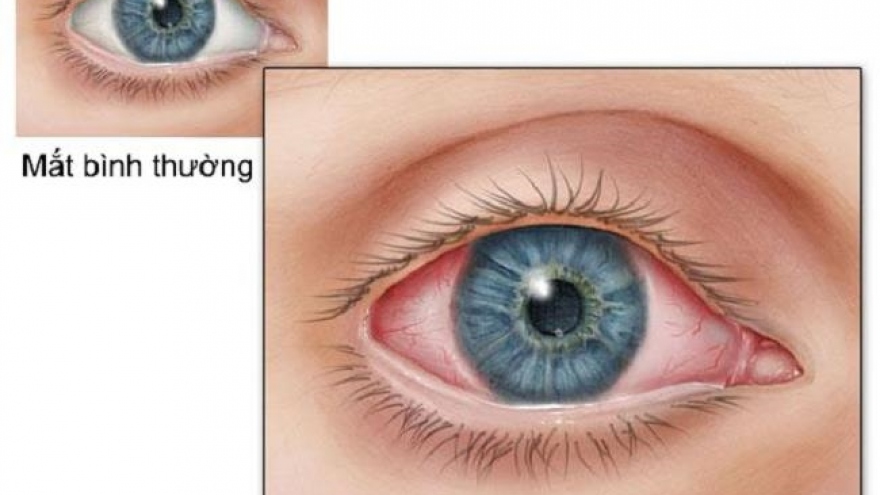 Trẻ bị đau mắt đỏ hậu COVID-19, cha mẹ nhất định phải nhớ điều này
