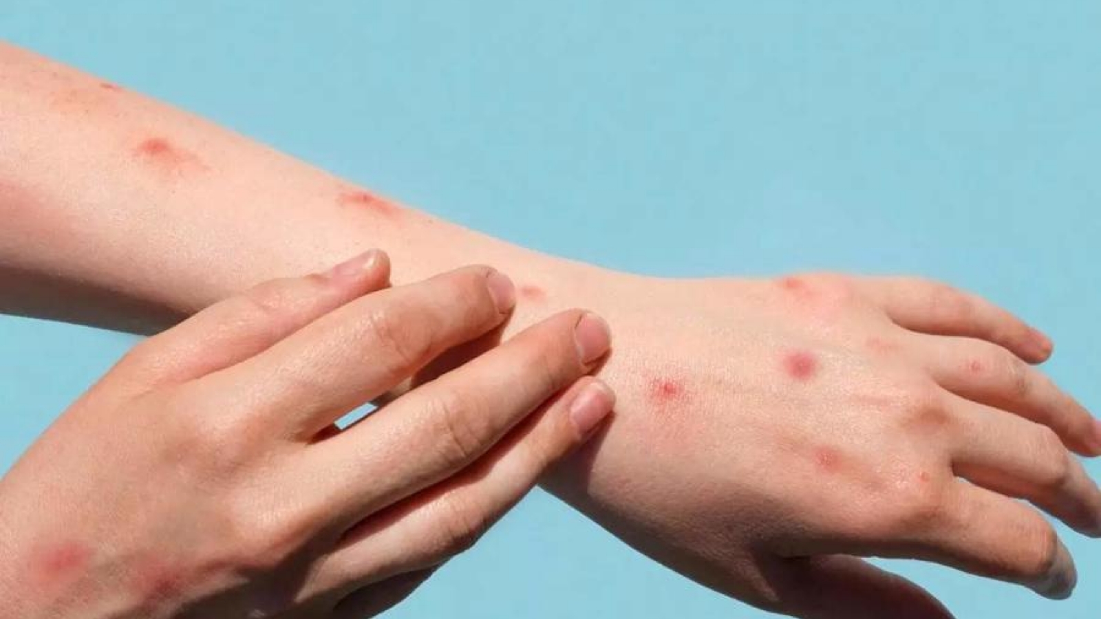 Vietnam tightens health quarantine against emerging diseases at borders 