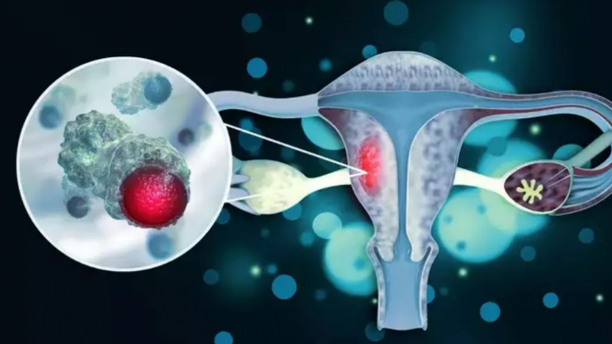 Nhiễm trùng lây qua đường tình dục: Nguyên nhân gây ung thư cổ tử cung?