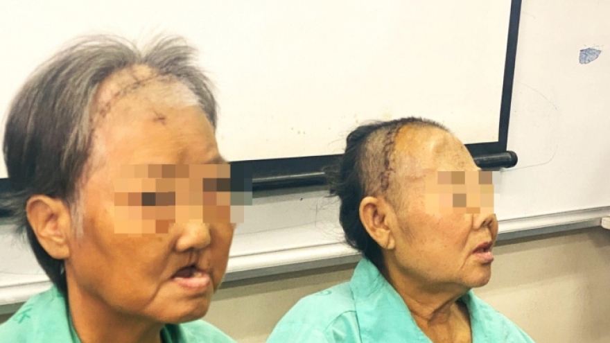 Hoại tử xương hàm sau Covid-19: Bác sĩ phân tích nguyên nhân