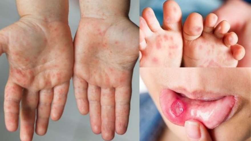 Hanoi sees fivefold jump in hand-foot-mouth disease cases 