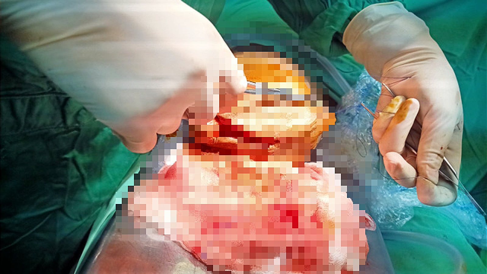  Nối thành công dương vật đã bị cắt lìa hơn 6 tiếng