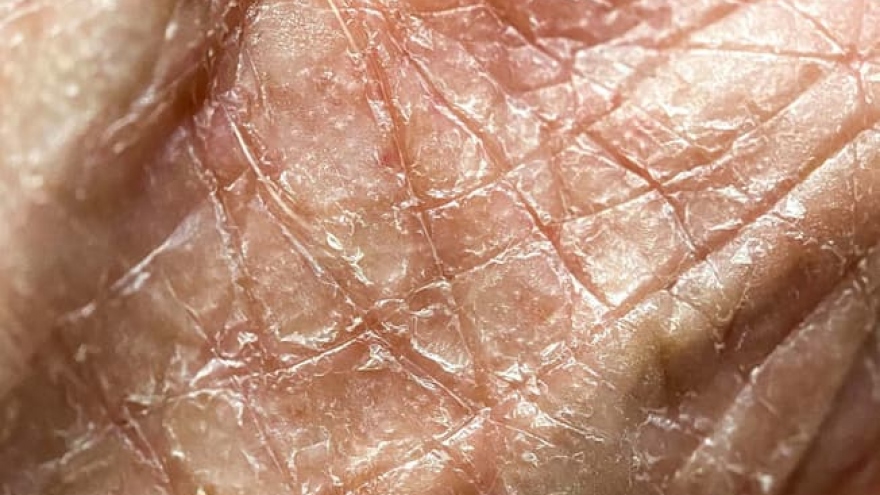 Những dấu hiệu cho thấy da của bạn đang mất nước