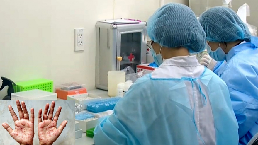 Vietnam to produce drugs against viral monkeypox 