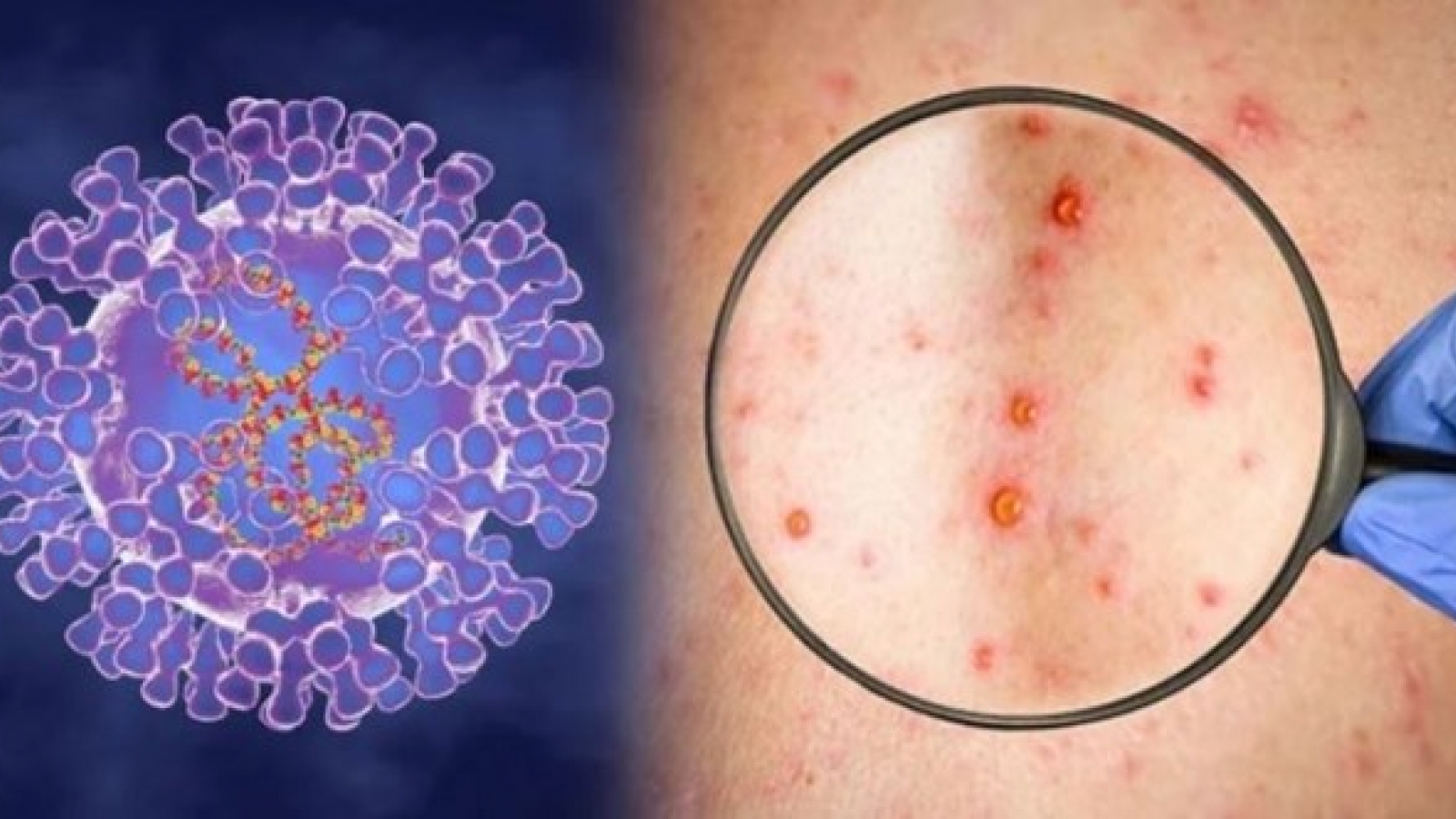 Ministry preparing response plans for monkeypox
