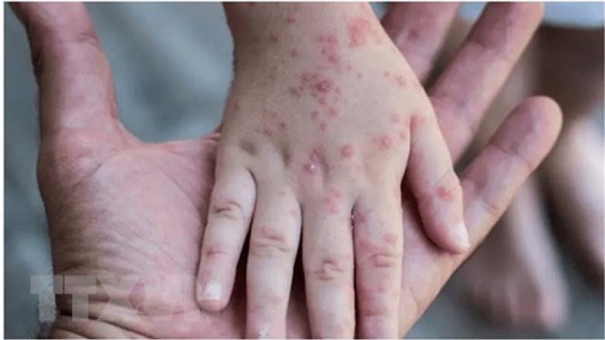 Vietnam monitors arrivals from countries with monkeypox