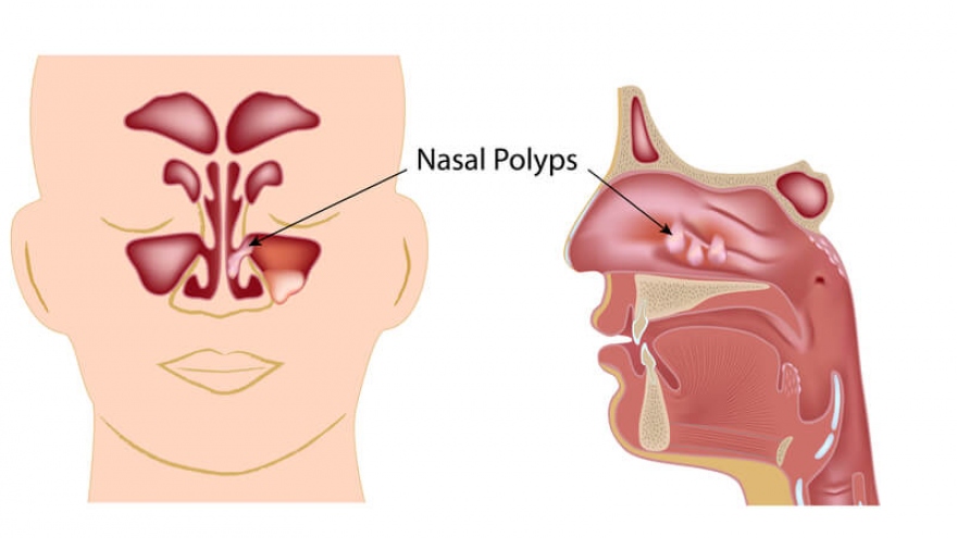 Bị polip mũi, trường hợp nào phải phẫu thuật?