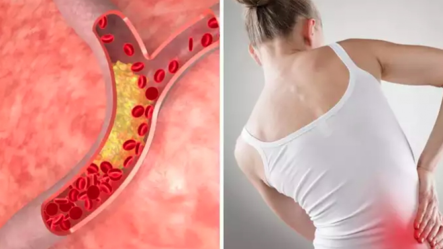 Đau ở 3 vùng này có thể là dấu hiệu của cholesterol cao