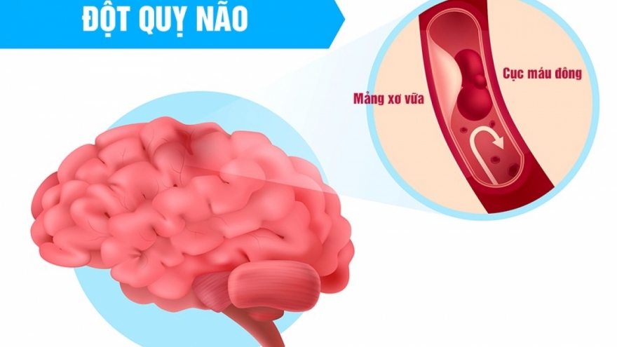 Quy tắc F.A.S.T giúp nhận diện sớm cơn đột quỵ