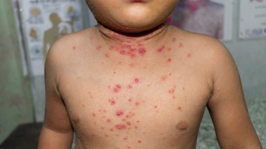 Vietnam adds monkeypox to group of infectious diseases