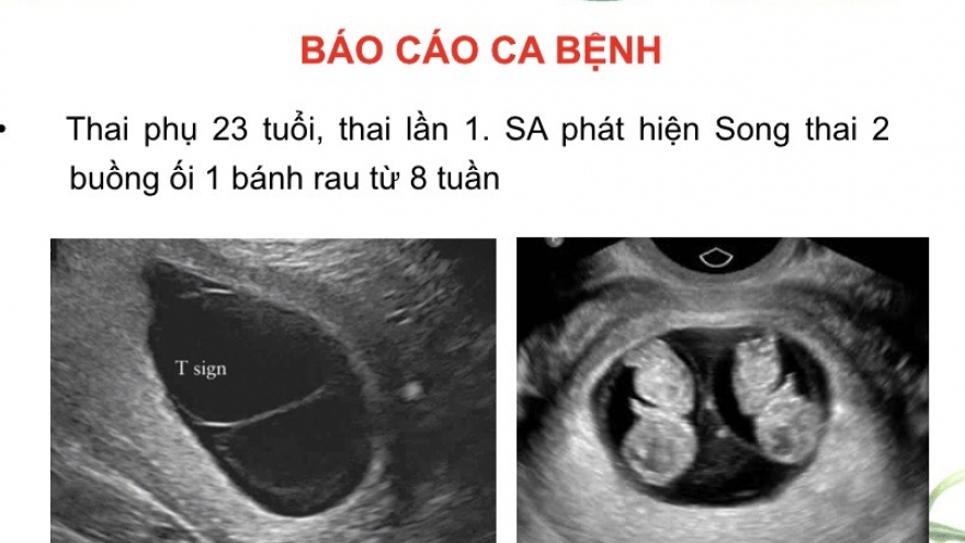 Công bố ca song thai cùng trứng cực kỳ đặc biệt, lần đầu ghi nhận tại Việt Nam