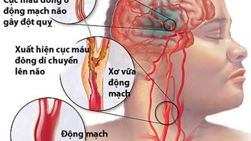 Chảy máu não - biến chứng nguy hiểm của sốt xuất huyết