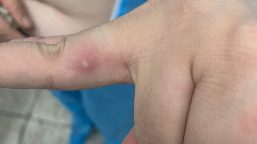Ca bệnh đậu mùa khỉ thứ 2 ở Việt Nam đã được xuất viện