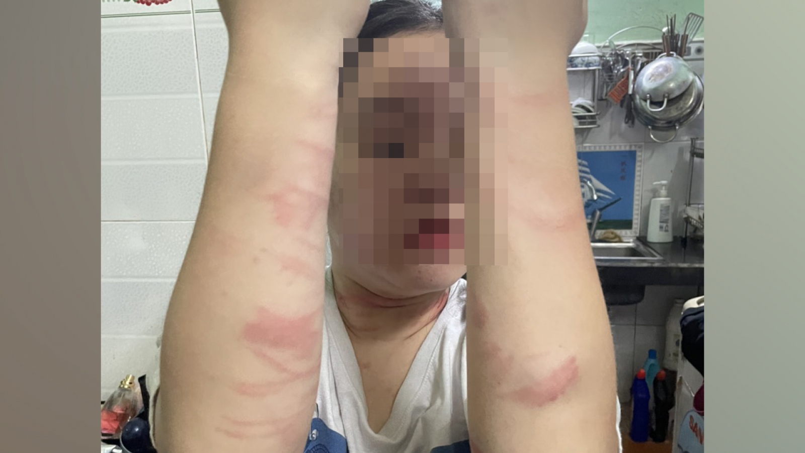 Điều tra vụ nữ sinh 17 tuổi nghi bị mẹ đánh thương tích ở TP.HCM