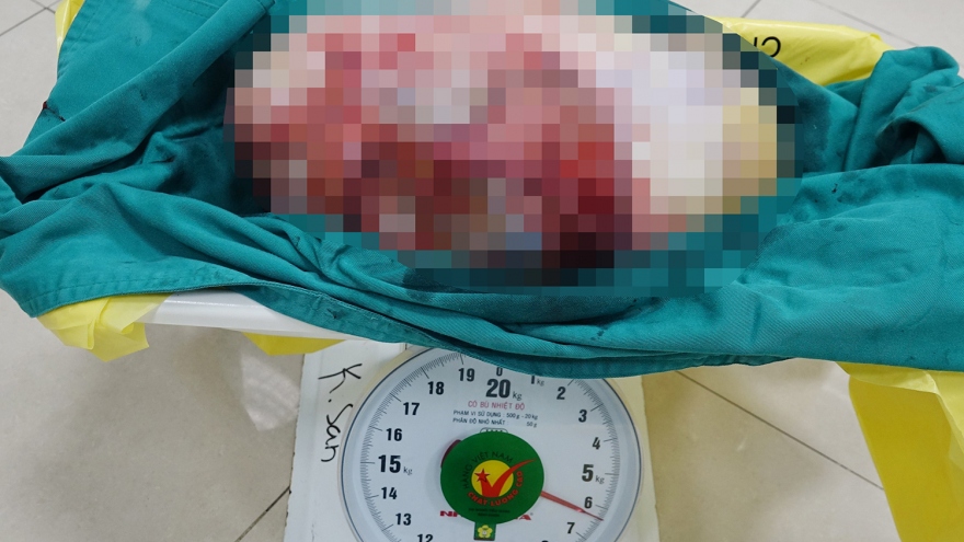 Cắt khối u hơn 6kg trong bụng cô gái 28 tuổi