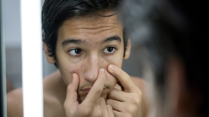 Cách chăm sóc da cho lứa tuổi dậy thì để ngăn ngừa mụn
