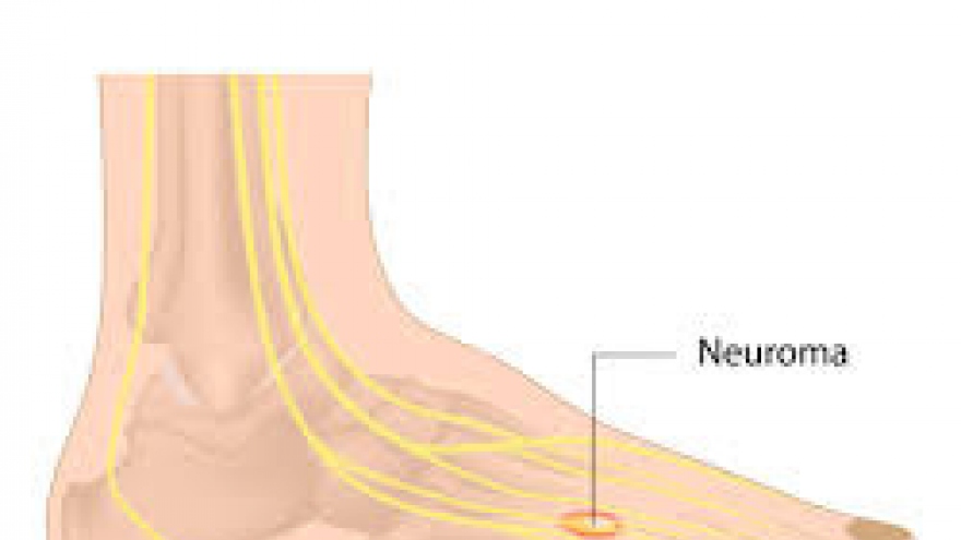 Vì sao nhiều người thừa cân béo phì cảm giác có vật lạ trong giày?