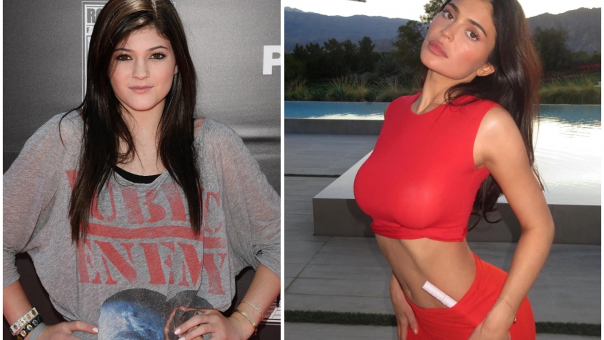 Kylie Jenner bị chỉ trích nói dối khi tuyên bố không phẫu thuật thẩm mỹ