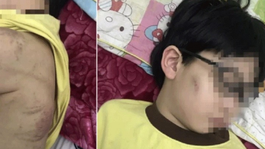 Chính quyền bác thông tin bé trai bị mẹ bạo hành phải nhập viện ở Quảng Ninh